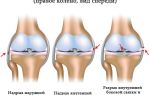 Восстановление связок коленного сустава после растяжения