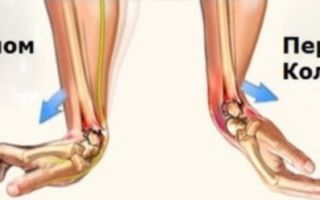 Rehabilitation after a fracture of the hand in the wrist joint