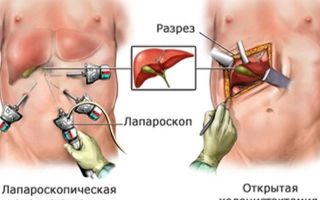 Rehabilitation after removal of the gallbladder