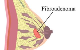 Реабилитация после удаления фиброаденомы молочной железы