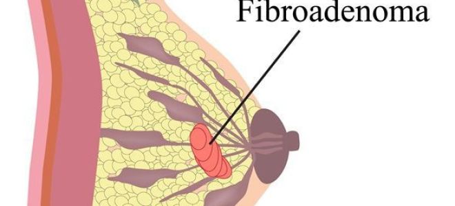 Rehabilitation after removal of breast fibroadenoma