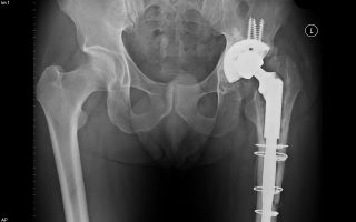 Rehabilitation after hip replacement