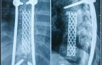 Rehabilitation after spinal surgery