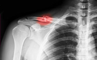 Rehabilitation after a fracture of the clavicle