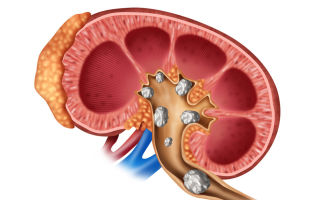 Rehabilitation after urolithiasis