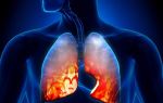 How to strengthen immunity after pneumonia in adults