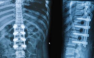 Rehabilitation after a spinal fracture