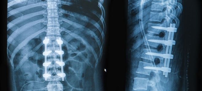 Rehabilitation after a spinal fracture