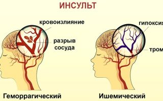 Народные средства лечения после инсульта