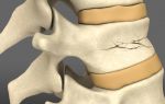 Rehabilitation after a compression fracture of the spine