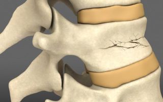 Rehabilitation after a compression fracture of the spine