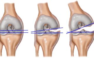 Реабилитация после ПКС коленного сустава