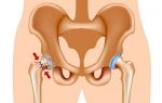 Реабилитация после перелома шейки бедра