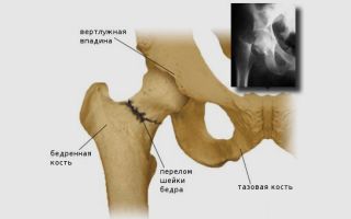 Rehabilitation after hip surgery