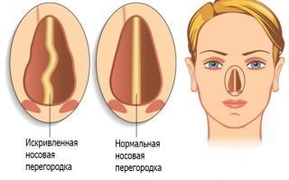 Rehabilitation after septoplasty of the nose