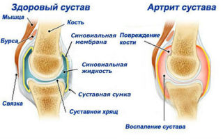 Medications for joint recovery