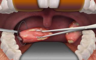 Recovery after tonsil removal