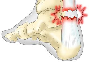 Rehabilitation after Achilles rupture