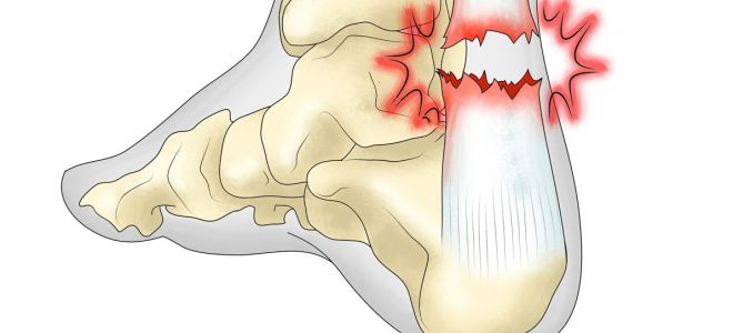 Rehabilitation after Achilles rupture