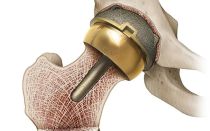 Rehabilitation after hip arthroplasty