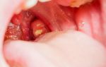 Rehabilitation after removal of the tonsils