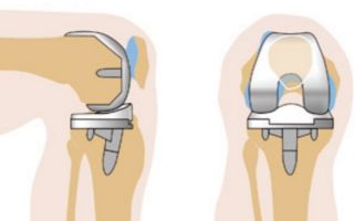 Восстановление после эндопротезирования коленного сустава