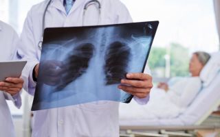 How is rehabilitation after pneumonia in adults