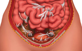 Adhesions after appendicitis