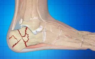 Rehabilitation after a fracture of the calcaneus