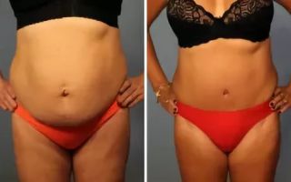 Recovery after abdominoplasty