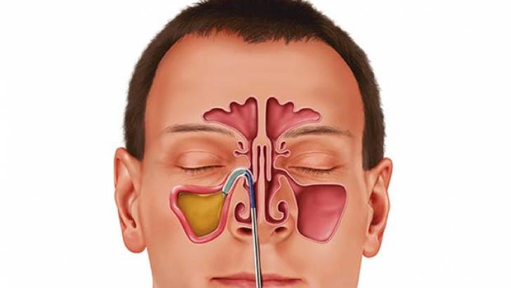Период после операции по удалению полипов в носу 