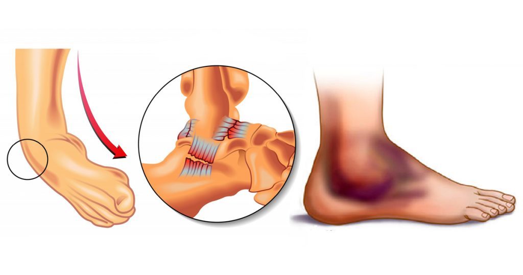 Симптомы растяжения связок голеностопного сустава