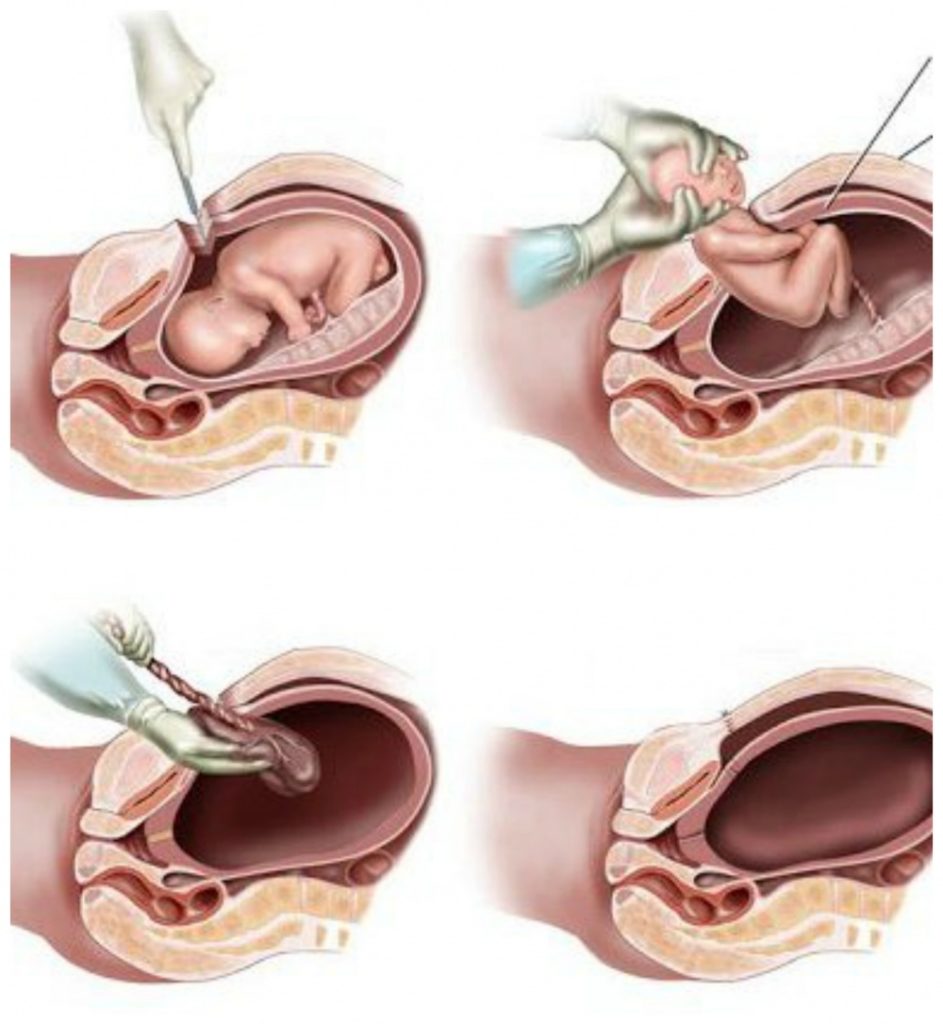 Features of recovery of the uterus after caesarean section