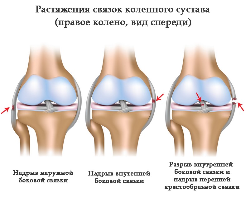 Постановка диагноза﻿ растяжение связок коленного сустава
