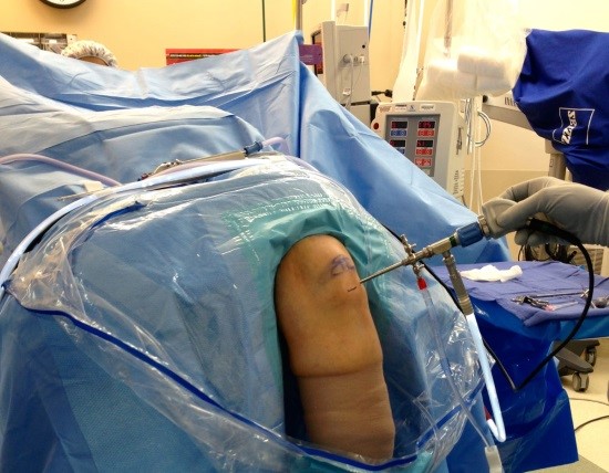 Реабилитация после артроскопии коленного сустава