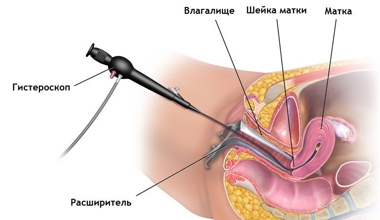 Лечение после удаления полипа эндометрия в матке