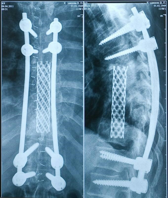Конструкция в позвоночнике фото
